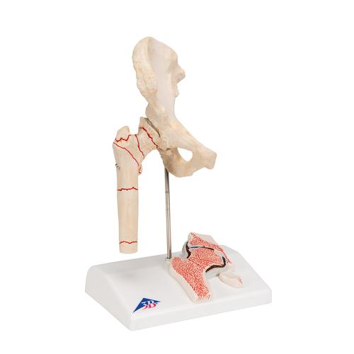 Femur kırık ve kalça osteoartriti - 3B Smart Anatomy, 1000175 [A88], Arterit ve osteoporoz