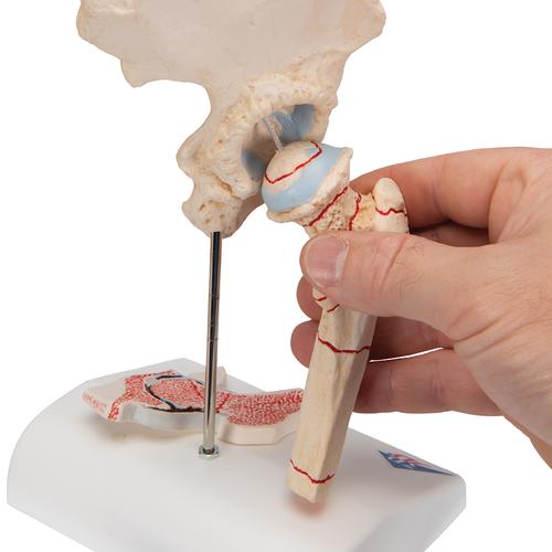 Femur kırık ve kalça osteoartriti - 3B Smart Anatomy, 1000175 [A88], Arterit ve osteoporoz