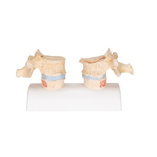 Osteoporoz Modeli - 3B Smart Anatomy, 1000182 [A95], Arterit ve osteoporoz