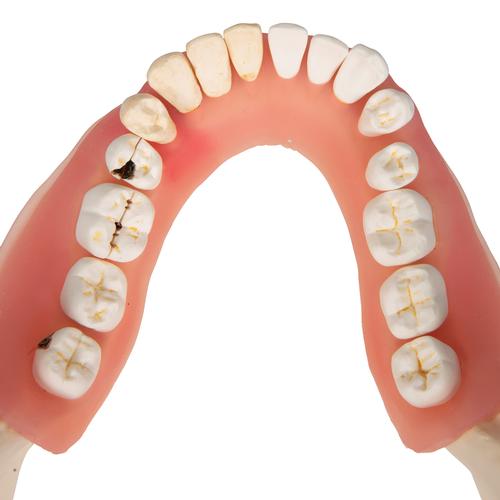 Diş Hastalıkları Modeli - 21 parça, 2 kat büyütülmüş - 3B Smart Anatomy, 1000016 [D26], Diş Modelleri