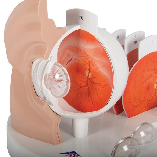 Patolojik Göz - 5 kez büyütülmüştür - 3B Smart Anatomy, 1017230 [F17], Göz Modelleri