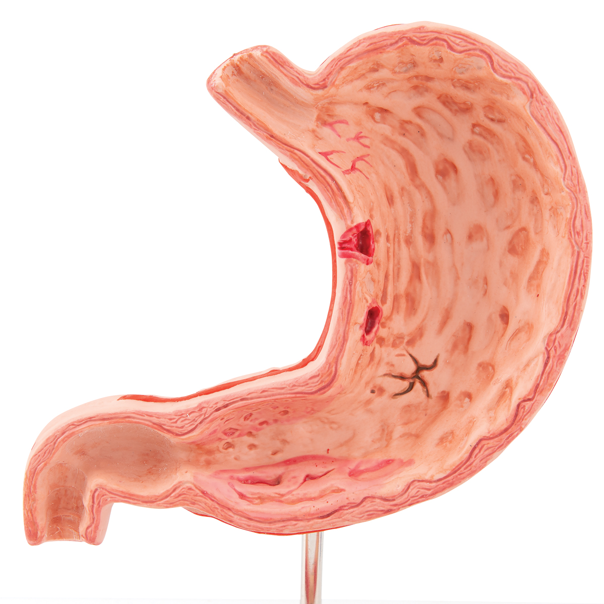 Anatomical Teaching Models Plastic Human Digestive Models Stomach With Ulce...
